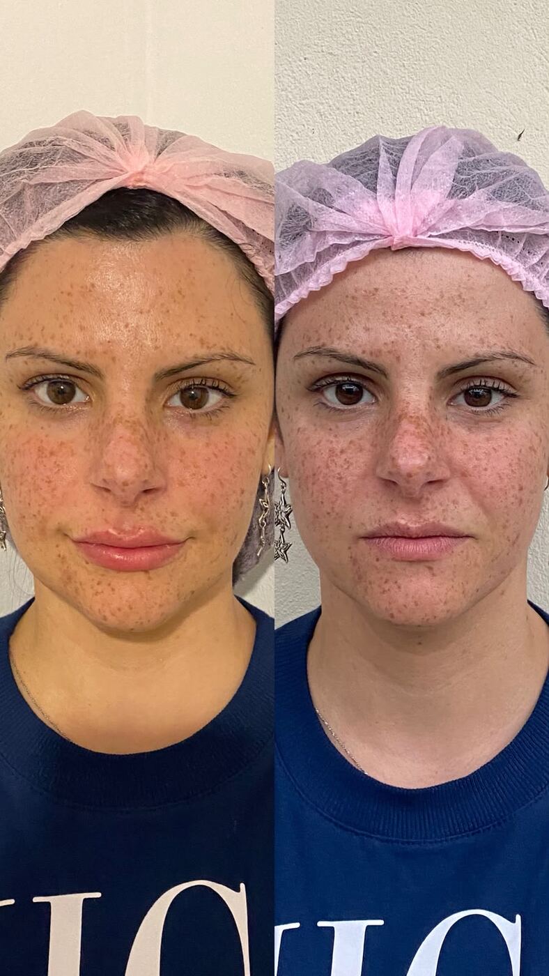 Antes e depois de tratamento de manchas no rosto
