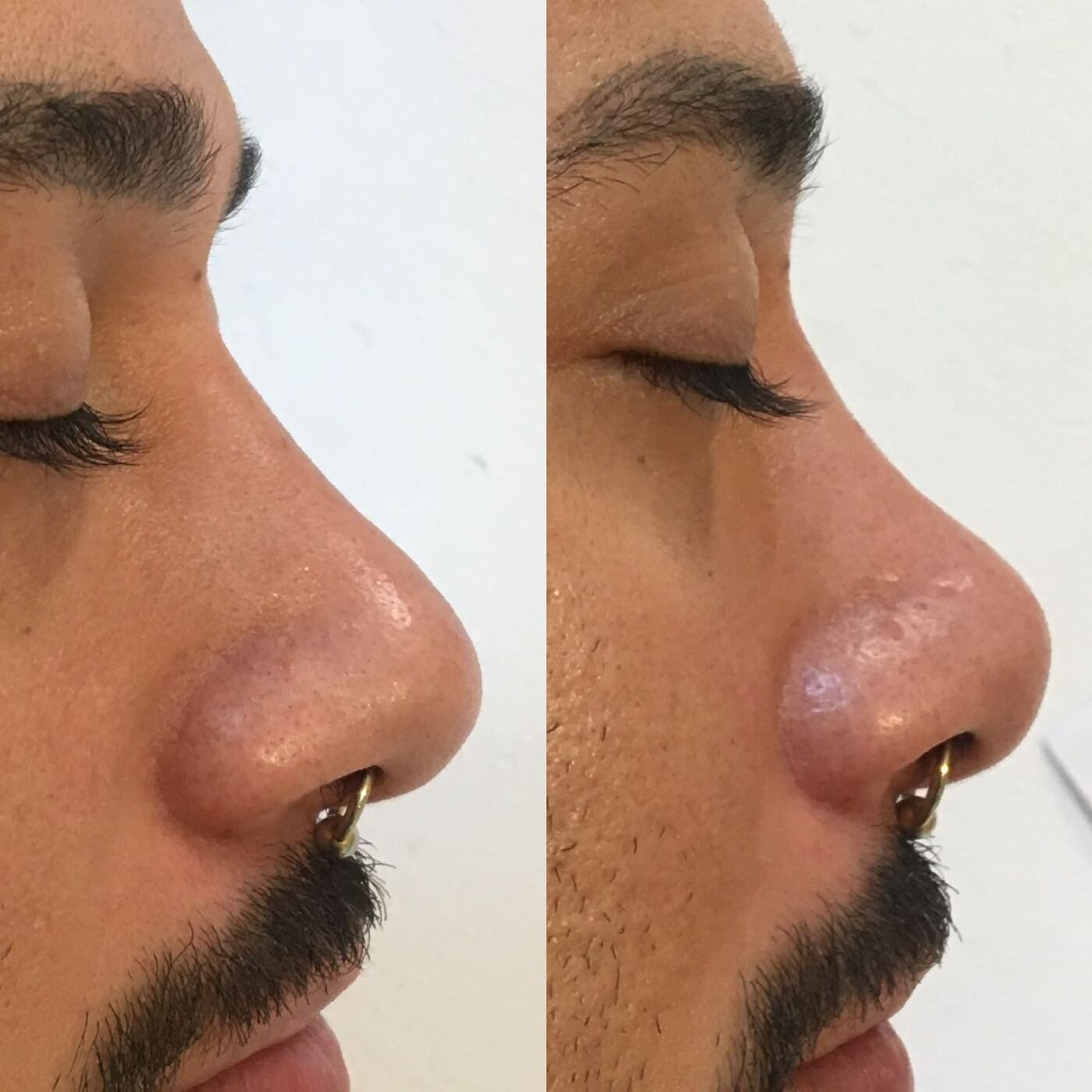 Antes e depois de rinomodulação