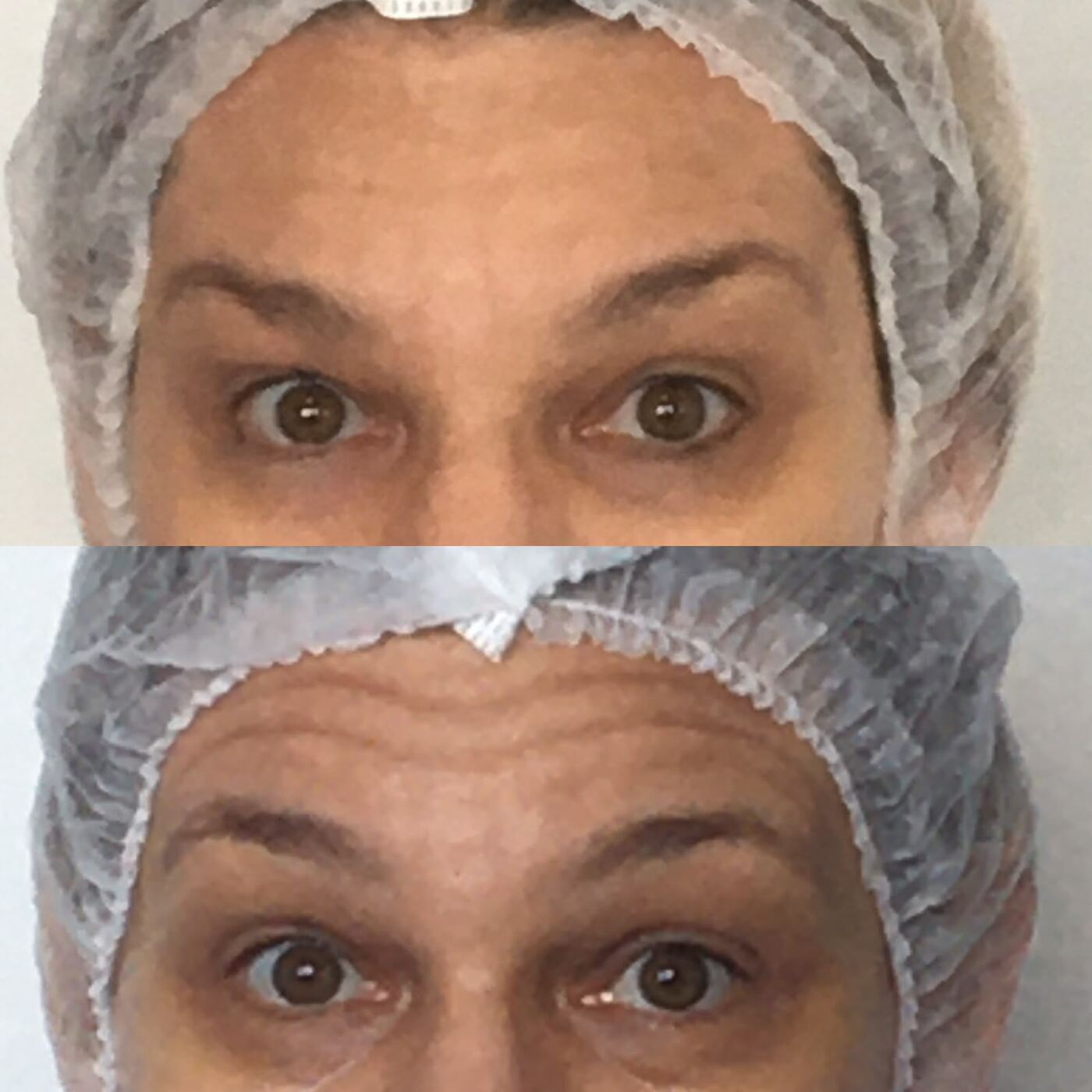 Antes e depois de rugas na testa