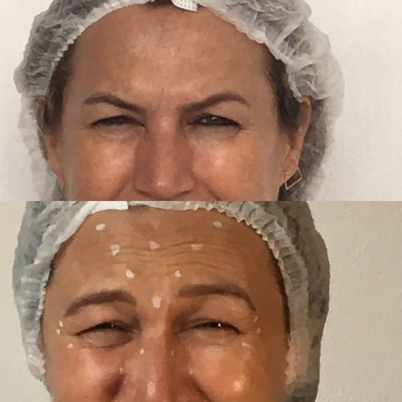 Antes e depois de rugas de expressão