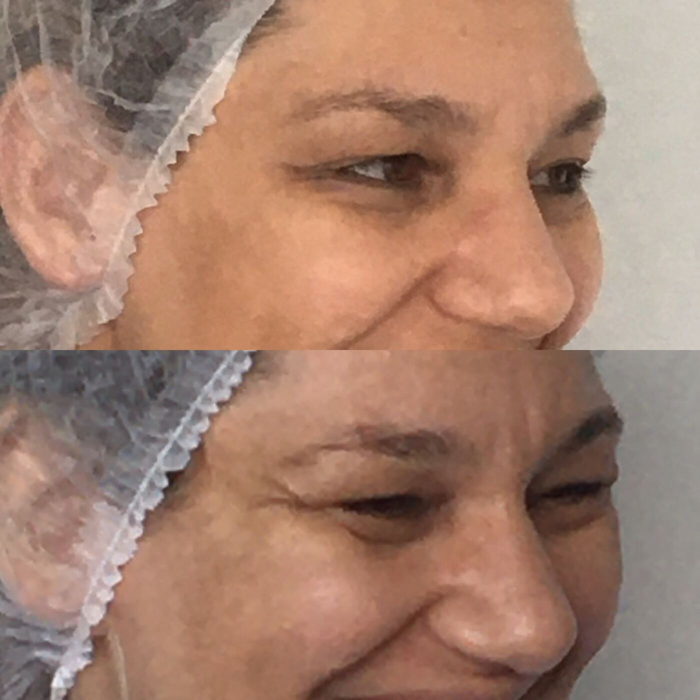 Antes e depois da região dos olhos