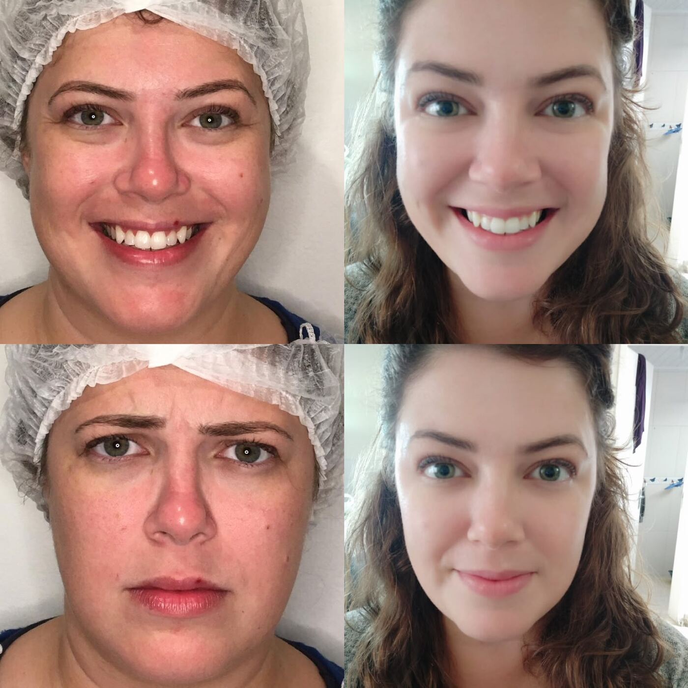 Antes e depois do rosto completo