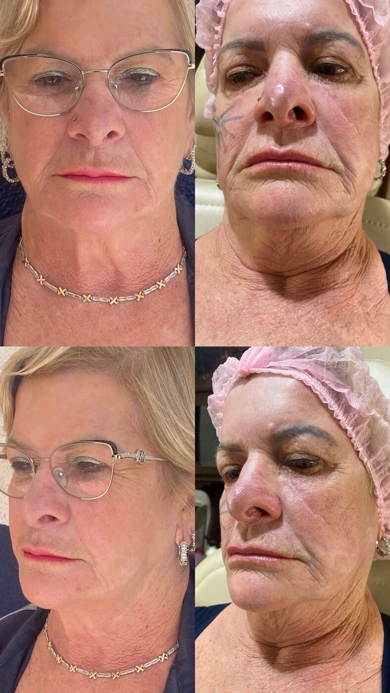 Antes e depois de tratamento facial de paciente da Dra. Andrea