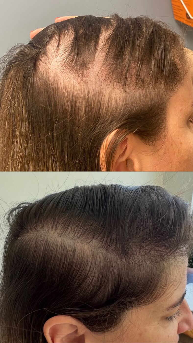 Resultado real: antes e depois do tratamento capilar, com couro cabeludo respondendo