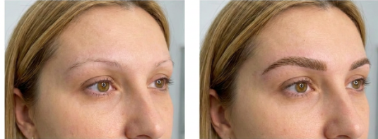 Antes e depois de transplante de sobrancelha com fios próprios
